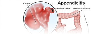 appendicitis