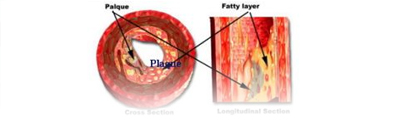 arteriosclerosis