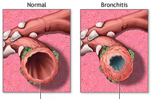 bronchitis