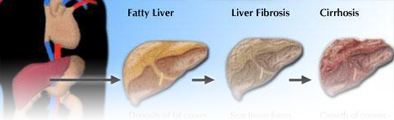 cirrhosis