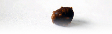 kidney stone