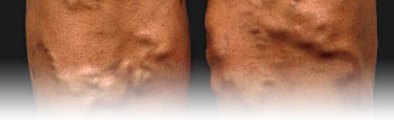 varicose veins