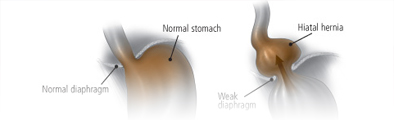 hiatus hernia