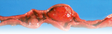 inflammation of the uterus