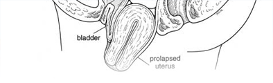 Prolapse of the uterus