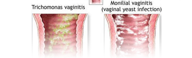 vaginitis